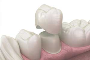 Ceramic Dental Implants In Vancouver WA from Lewis Family and Implant Dentistry