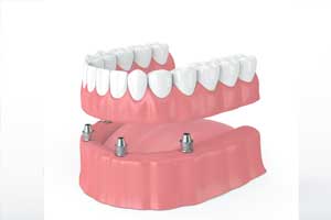 Implant Supported Dentures In Vancouver WA from Lewis Family and Implant Dentistry