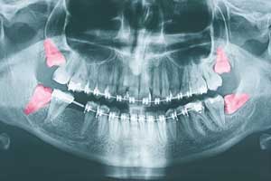 Wisdom Teeth Extraction In Vancouver WA from Lewis Family and Implant Dentistry