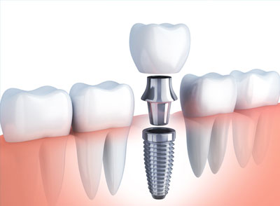 Can Dental Implants be Removed