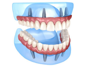 All-On-4 Dental Implants at Lewis Family Dentistry in Vancouver WA