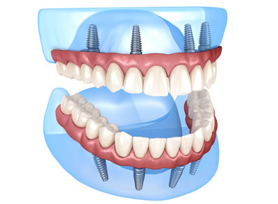 Can I replace all my teeth with dental implants