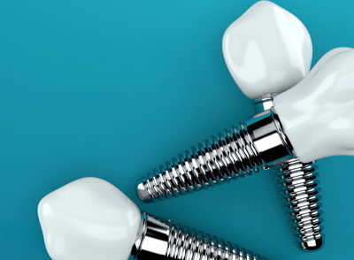 What are Dental Implants Made of