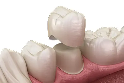 Ceramic Dental Implants In Vancouver WA from Lewis Family and Implant Dentistry