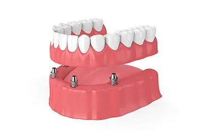 Implant Supported Dentures In Vancouver WA from Lewis Family and Implant Dentistry