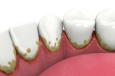 Plaque vs. Tartar: Differences, Prevention, and Treatment with Lewis Implant Dentistry in Vancouver