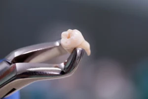 closeup of an extracted tooth