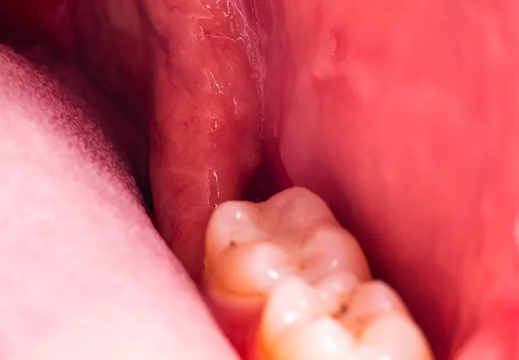 close up view of a dry socket in a mouth