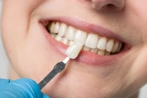 Closeup of a person smiling with veneers