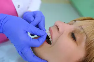 A dentist holding a veneer over a patient's tooth, trying to match the correct shade. Call or contact Lewis Family & Implant Dentistry to schedule your dental veneer consultation.